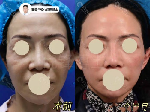 上海百达丽医疗美容倪峰拉皮手术对比照