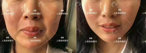 上海薇琳医疗美容医院拉皮手术对比照