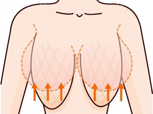 胸部下垂自体脂肪隆胸合适吗？和假体隆胸哪个更好？