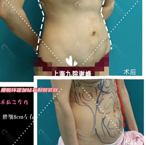 上海九院谢峰做腰腹环吸术前术后对比照片