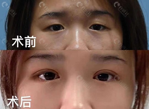 深圳米兰柏羽医疗美容医院朱武根院长割双眼皮对比照
