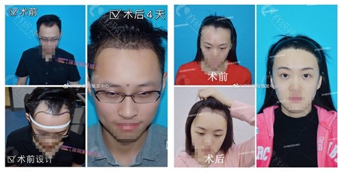 深圳鹏程医院植发科发际线种植术前术后对比图展示