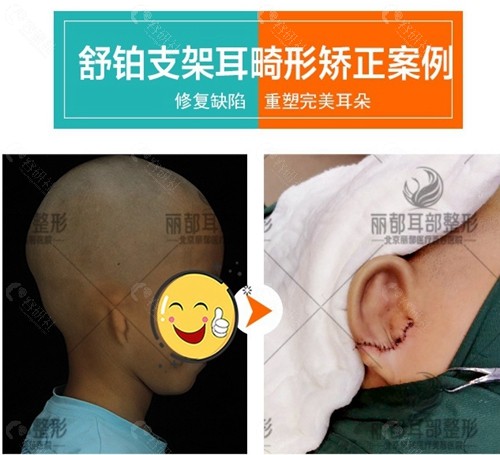 北京丽都安波耳畸形矫正前后对比照片
