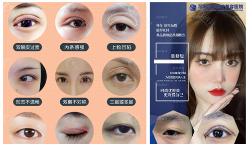 深圳富华医疗美容医院双眼皮修复对比效果图