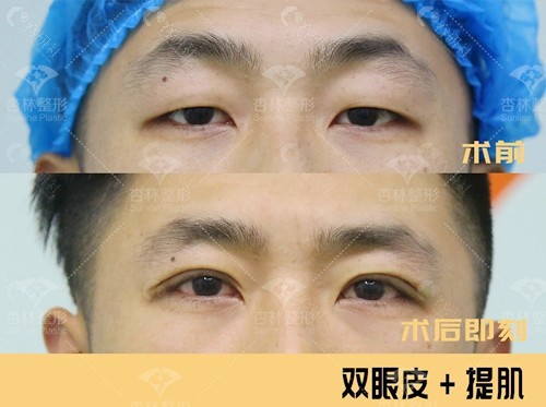 沈阳杏林割双眼皮+提肌手术前后对比图
