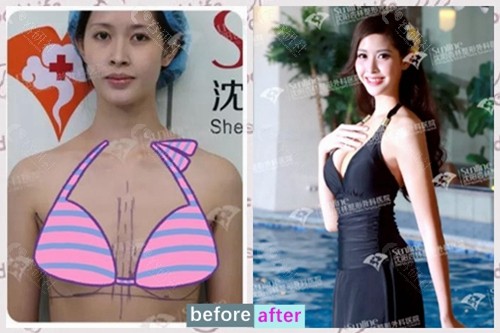 泰国变性人选美皇后找沈阳杏林崔昌墉隆胸前后图片