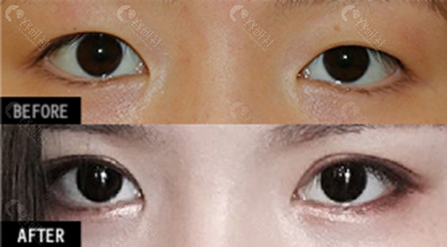 韩国爱护医院朴炳浩院长割双眼皮对比照