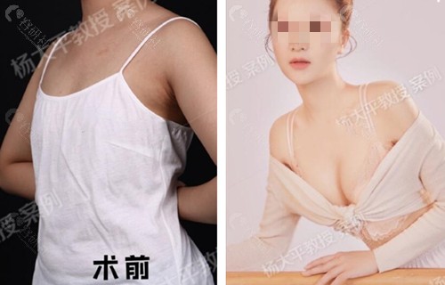 北京联合丽格杨大平假体隆胸前后对比照
