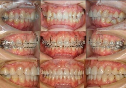 上海鼎植口腔牙齿矫正术前术后对比