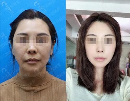 北京加减美面部法令纹改善前后效果对比