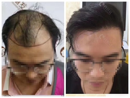 新生雄脱植发十个月后效果