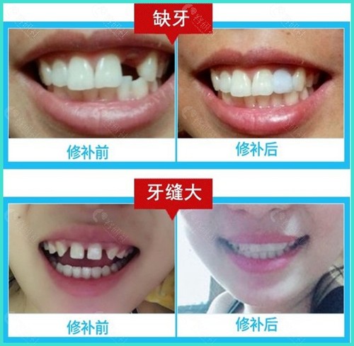 缺牙和牙缝大修补前后对比图