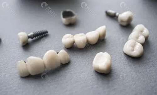2021年北京种植牙牙冠收费标准