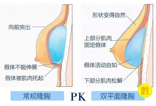 双平面隆胸和普通隆胸的区别