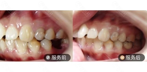 深圳维港谢立华医生单颗种植牙前后对比照