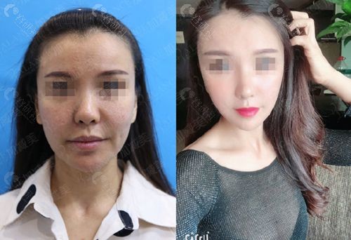 北京加减美面部提升对比照