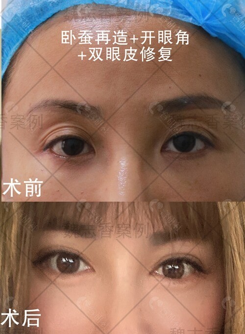 北京丽星翼美眼修复中心魏志香双眼皮修复对比照