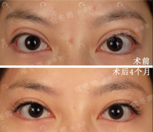 北京尚益嘉容医疗美容常冬青医生双眼皮修复对比照