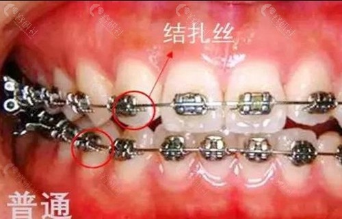 北京传统金属托槽牙齿矫正价格