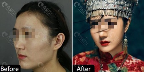 上海首尔丽格石润下颌角整形术前术后对比