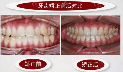 许昌京州口腔牙齿矫正前后对比