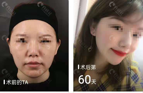 武汉艺星医疗美容医院面部提升对比照