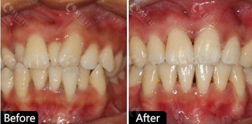 西安诺贝尔口腔牙齿矫正术前术后对比