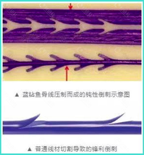 强生蓝钻鱼骨线与普通提升线材有什么区别？