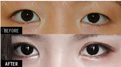 韩国爱护医院朴炳浩院长割双眼皮对比照