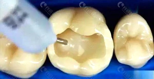 临床上常见的补牙材料复合树脂材料