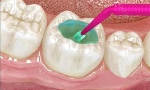 临床上常见的补牙材料纳米树脂材料