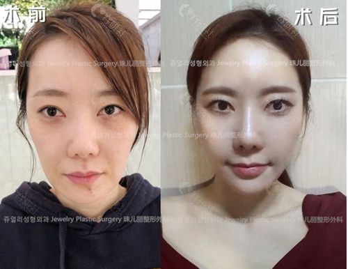 韩国珠儿丽拉皮手术前后对比照
