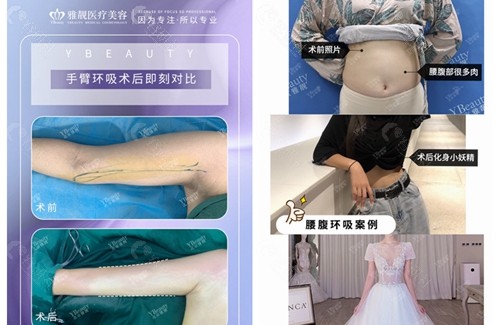 北京雅靓整形医院手臂吸脂和腰腹吸脂对比图