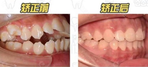 长沙美奥口腔医院牙齿矫正术前术后对比