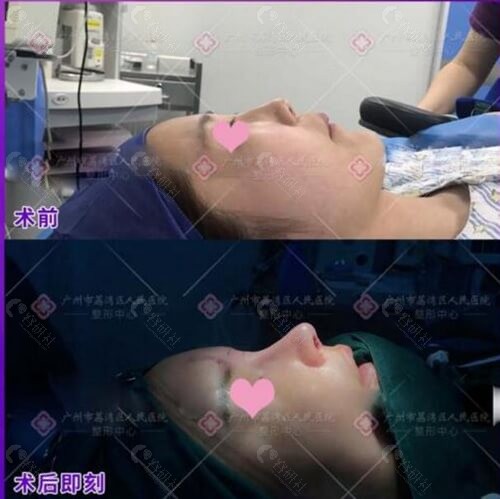 广州荔湾区人民医院整形美容中心隆鼻术后即刻效果