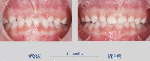 银川诺贝尔口腔牙齿矫正术前术后对比