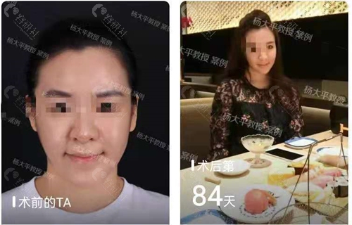 北京联合丽格医疗美容拉皮手术对比照