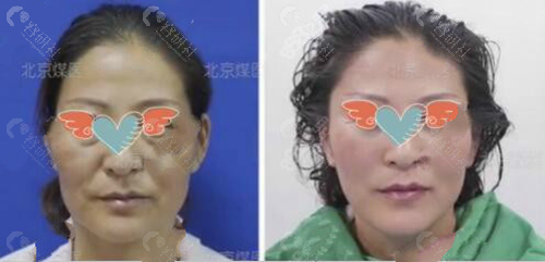 北京煤医医疗美容医院拉皮手术对比照