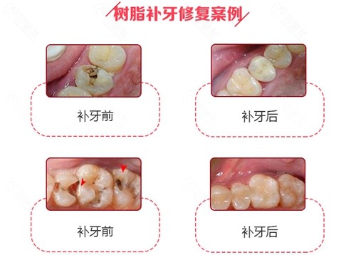 北京看牙好的医院树脂补牙对比图
