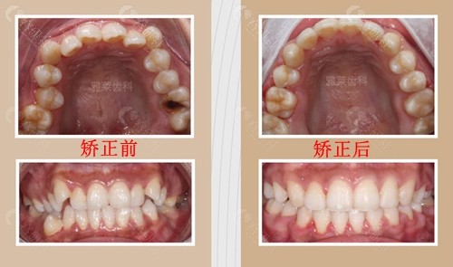 杭州雅莱口腔牙齿矫正前后效果对比图