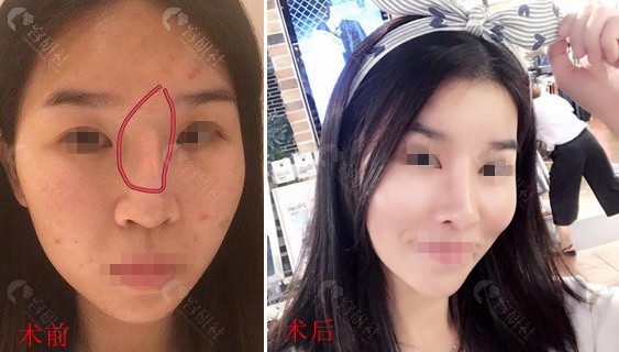 北京华韩医生王义山鼻部修复对比照