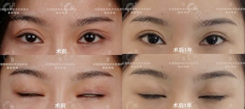 上海联合丽格眼部整形医生杜园园双眼皮失败修复术前术后1年对比照