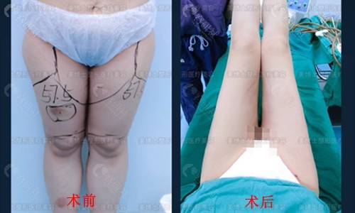 漳州美博士医疗美容大腿吸脂术前术后对比图