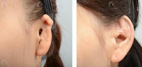 单侧小耳畸形会影响听力吗？耳再造能和听力重建一起做吗