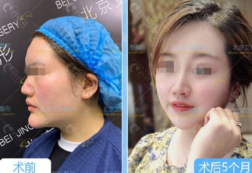 北京艾玛李方奇下巴生长因子取出对比照