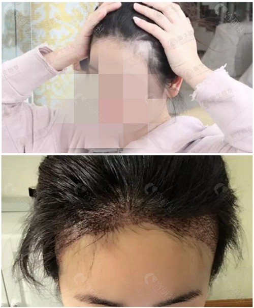 广州新生植发发际线种植前后效果对比
