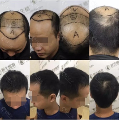 广州新生植发男士头顶加密种植术后效果