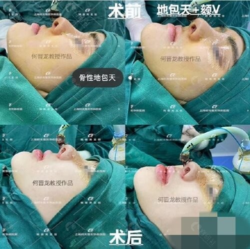 上海时光整形外科医院何晋龙正颌手术前后对比图