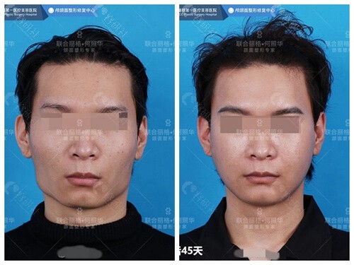 北京联合丽格何照华医生下颌角截骨对比照片