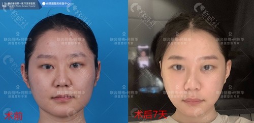 北京联合丽格何照华医生下颌角磨骨前后对比图分享